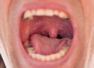 6 Esophageal cancer symptoms in throat
