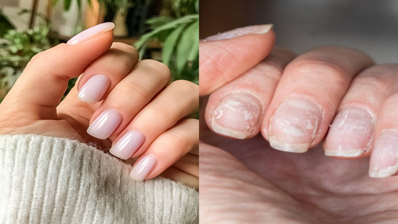 Nails begin separating from nail bed recently. No trauma, no pain, no  fungal infection. What is going on... Will it heal? : r/Dermatology