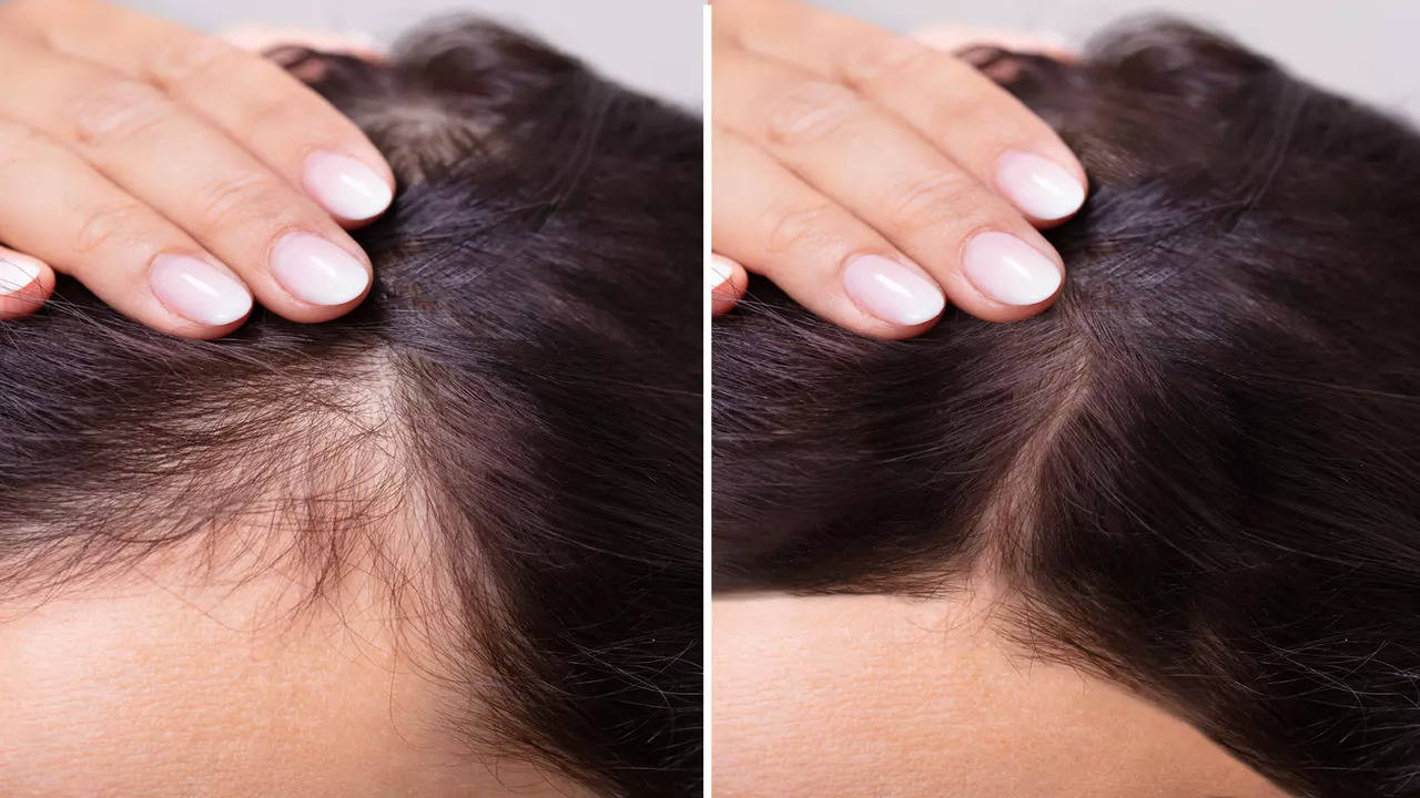 All about hair loss, prevention and its treatment - Times of India