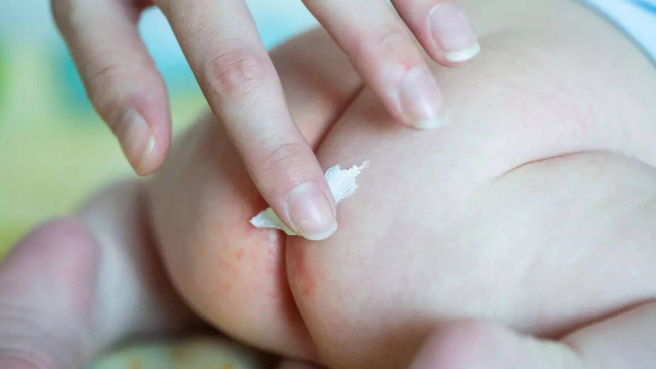 Diaper Rash or Yeast Infection How to Tell the Difference Times Reviews