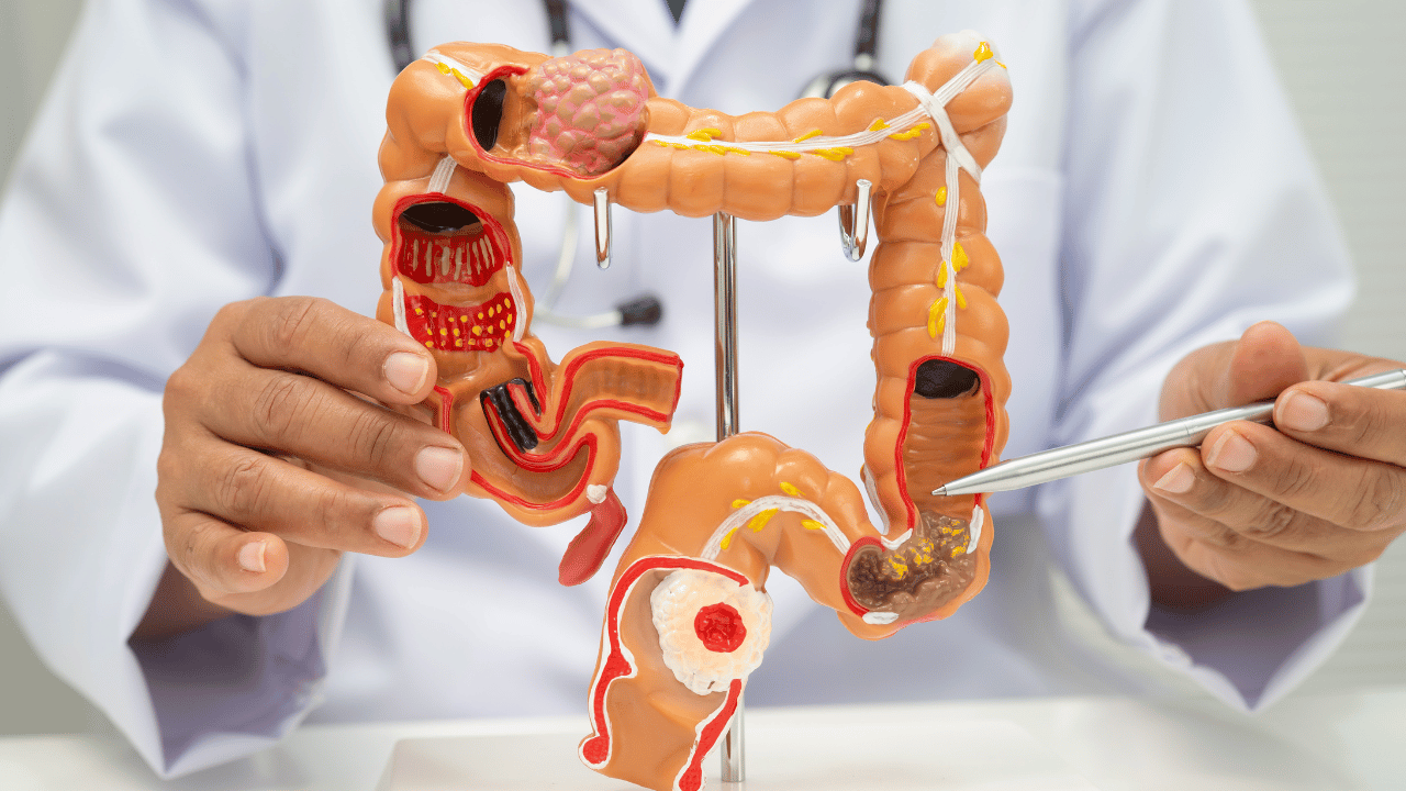 76-year-old woman diagnosed with rare small intestine cancer undergoes complex surgery involving the bowel, colon and liver