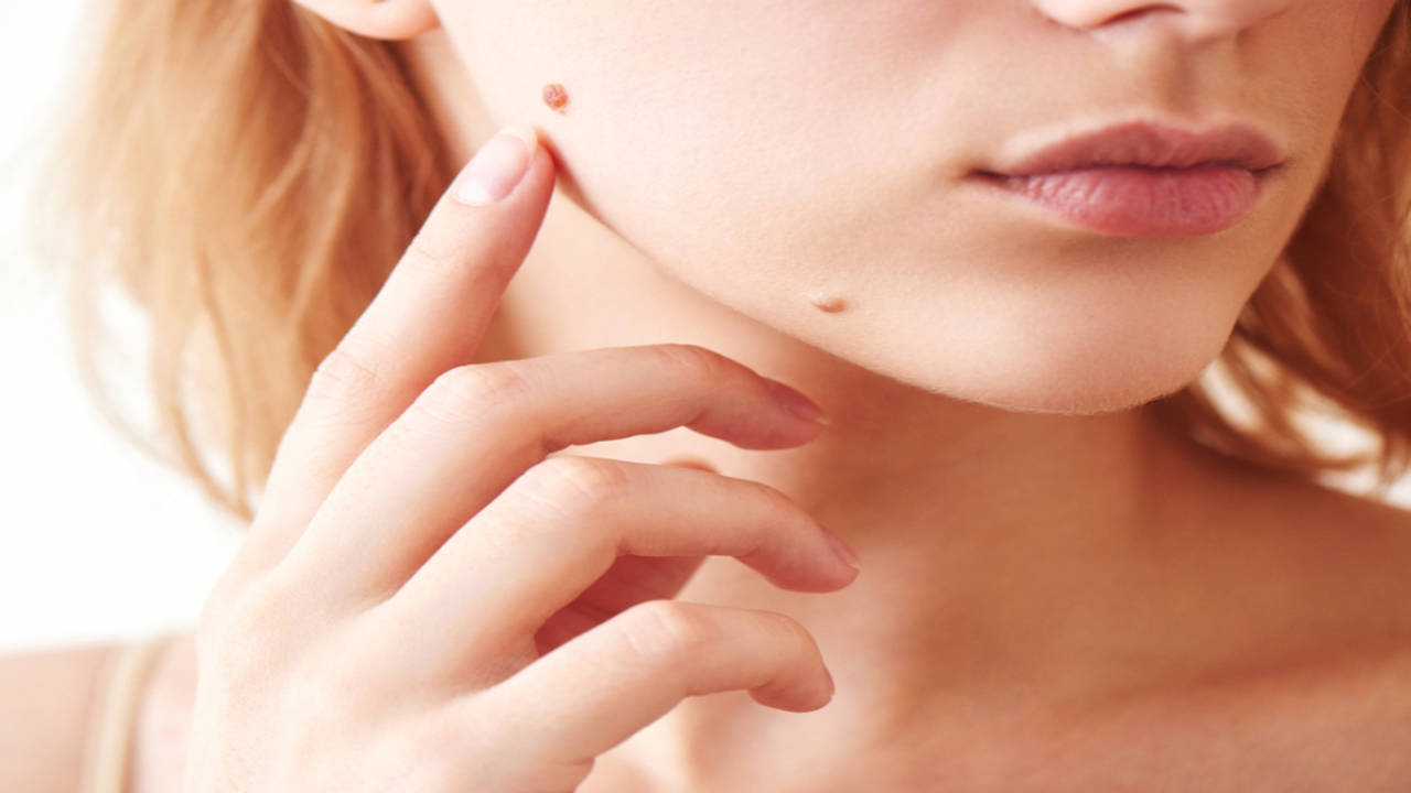When to Be Concerned About a Child's Mole - Forefront Dermatology
