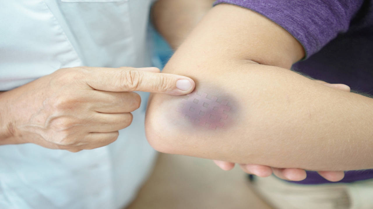 Bruises on dark skin: Symptoms and treatment