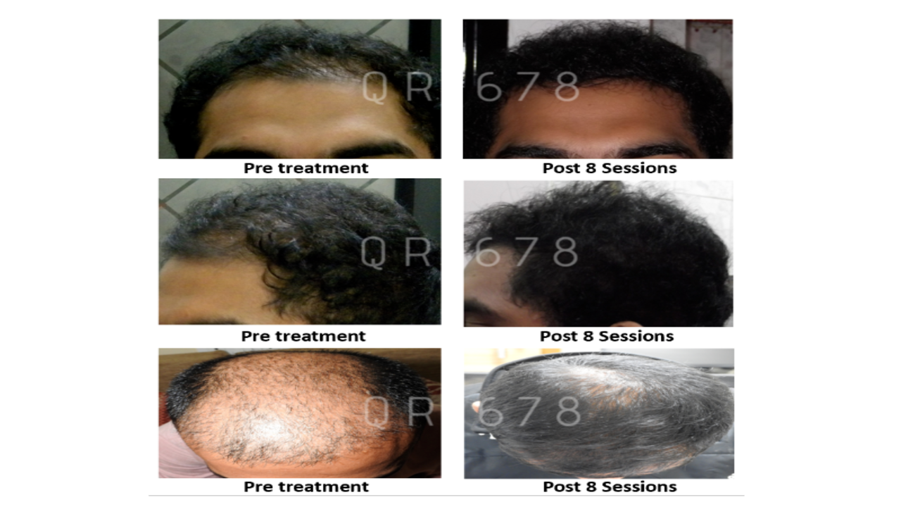 Hair Loss Treatment Hair Loss Cure In Navi Mumbai  View Doctors Book  Appointment Online  Practo