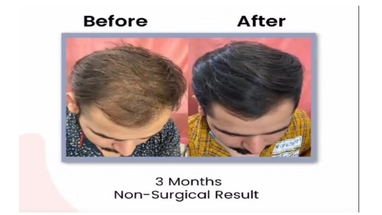 Best Hair Transplant clinics in Mumbai 2023