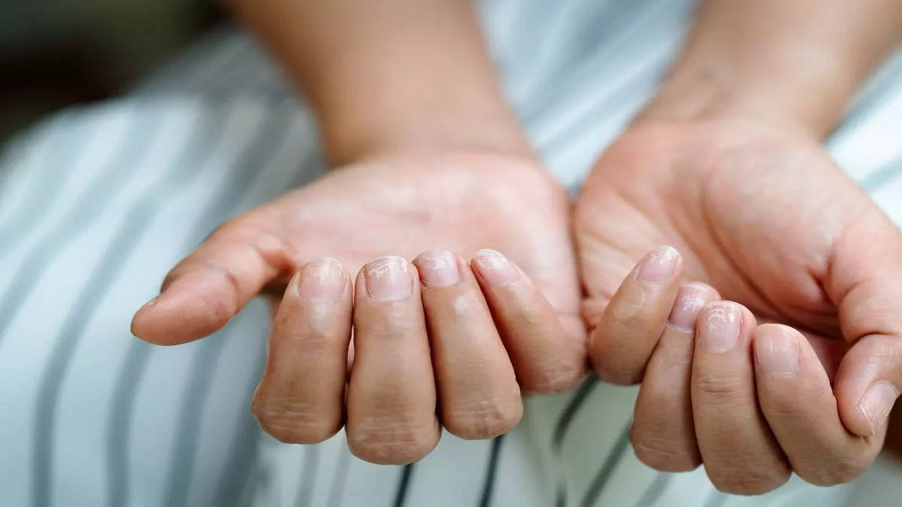 How the colour of your nails can reveal cancer | The Times of India