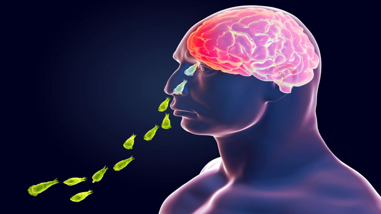 Brain-Eating Amoeba Symptoms: From Severe Headache To, 58% OFF