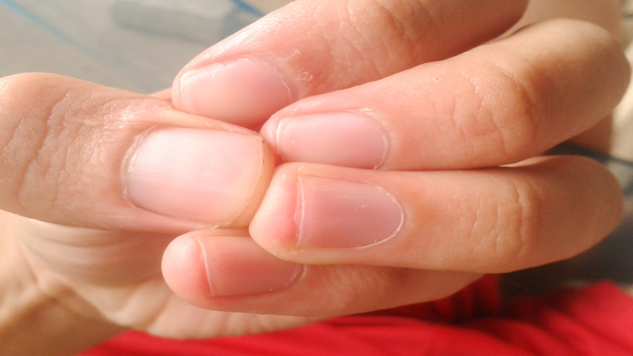 Clubbing of the Fingers or Toes