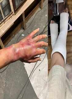 Taapsee Pannu shares photos of her "injured hand" and "fractured legs"