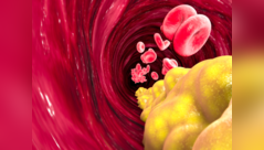 High cholesterol: How it affects body