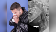 Man tears windpipe after trying to hold in a sneeze