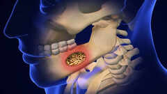 What is Mouth Larvae: Know its causes, symptoms, prevention strategies, and treatment