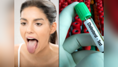 Tongue color may signal high cholesterol