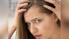 Women too suffer from receding hairline