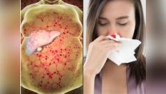 Nosebleed is a warning sign of fatty liver