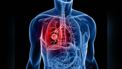 Lung cancer: Unusual signs you must know