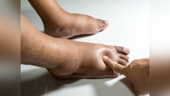 5 initial signs of diabetic kidneys