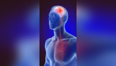 4 stroke symptoms seen in 75% of cases
