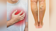 Swelling in legs may be sign of heart failure