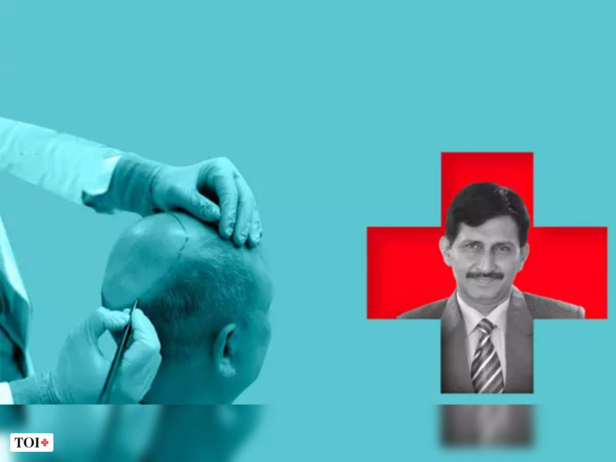 Body Hair Transplant in Delhi  Hair Transplant Myth And Facts  Discussed  by drchandra01  Issuu