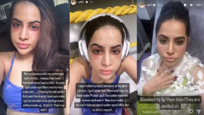 Urfi Javed: Uorfi Javed reveals her under eye fillers went horribly wrong;  says 'My Face Looks F***ed Up' | - Times of India
