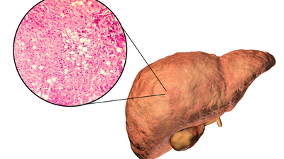 Can vitamin B12 deficiency lead to fatty liver disease? Causes, symptoms, and treatment